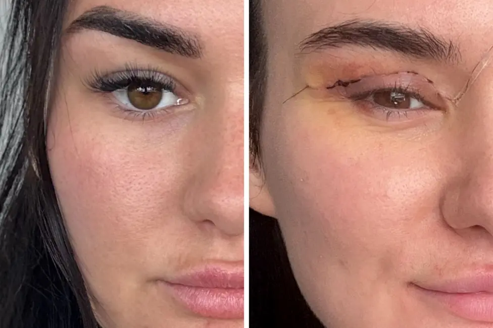 Why Research Matters Before Choosing Your Eyelid Surgeon